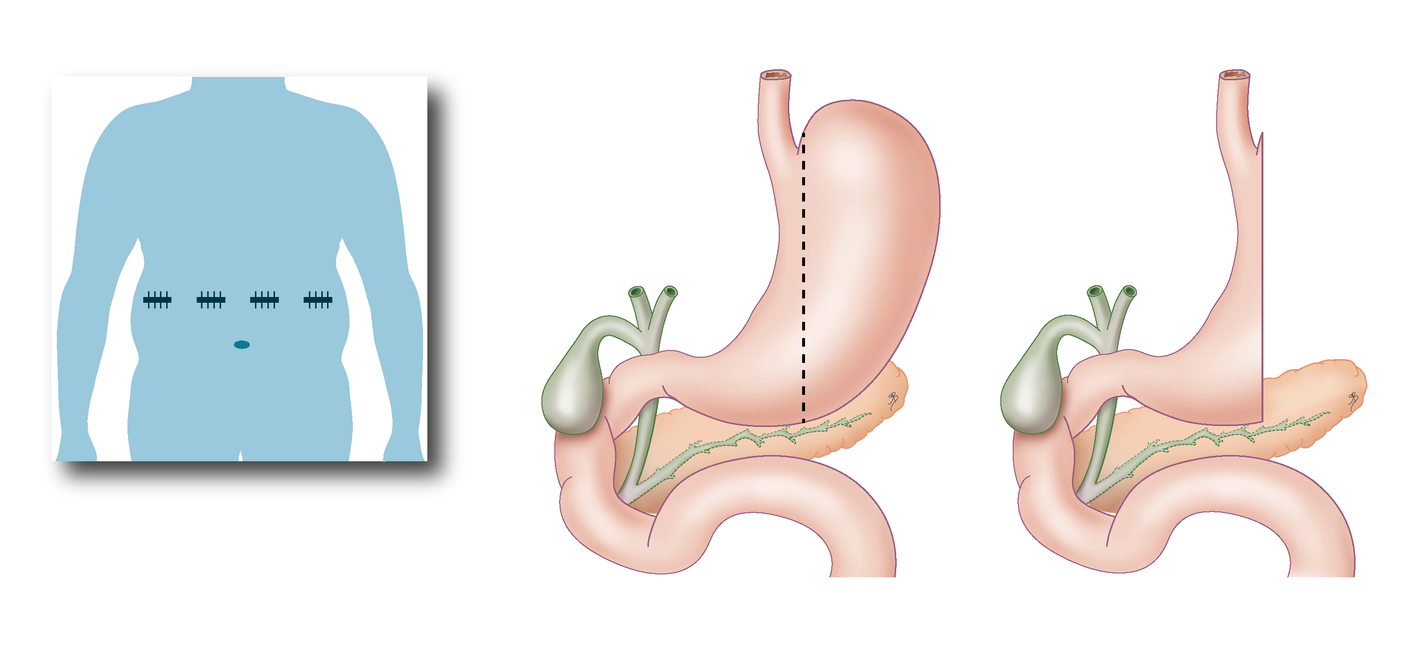 Sleeve gastrectomie